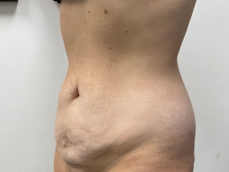 Tummy Tuck Before & After Gallery - Patient 318654 - Image 9