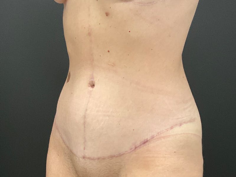 Tummy Tuck Before & After Gallery - Patient 318654 - Image 10