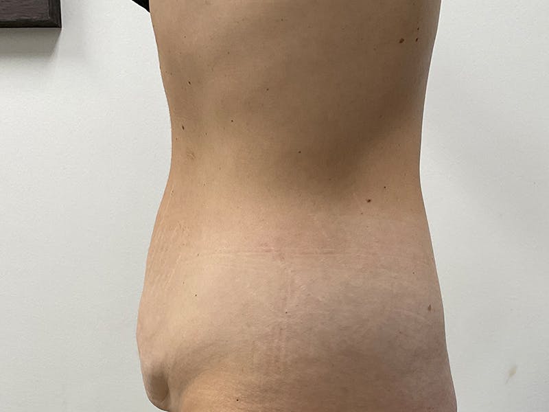 Tummy Tuck Before & After Gallery - Patient 318654 - Image 7