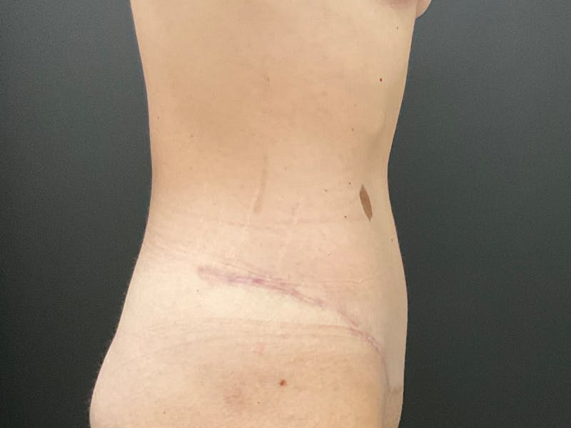 Tummy Tuck Before & After Gallery - Patient 318654 - Image 6