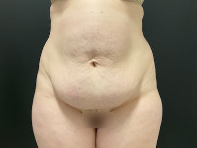 Liposuction Before & After Gallery - Patient 163756 - Image 1