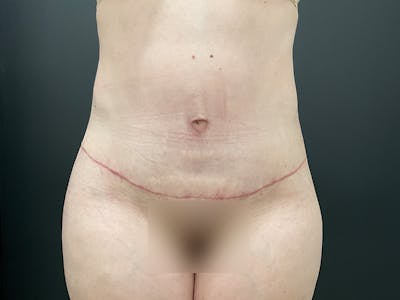 Liposuction Before & After Gallery - Patient 163756 - Image 2