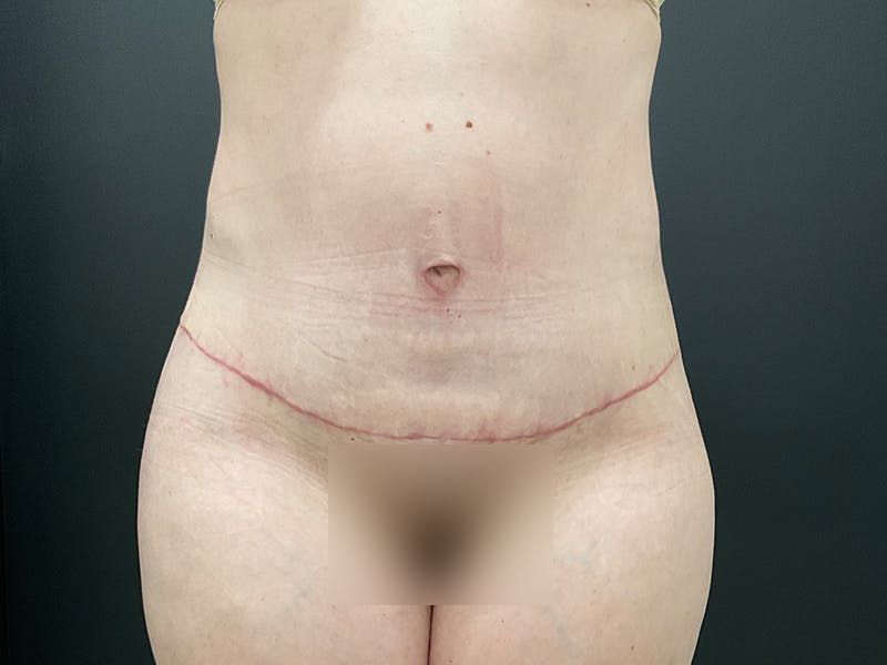 Liposuction Before & After Gallery - Patient 163756 - Image 2