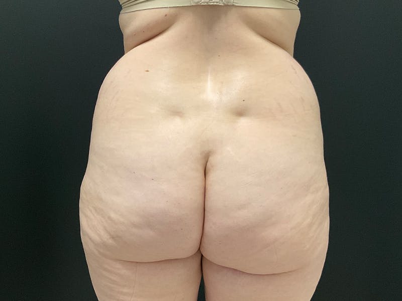 Liposuction Before & After Gallery - Patient 163756 - Image 3