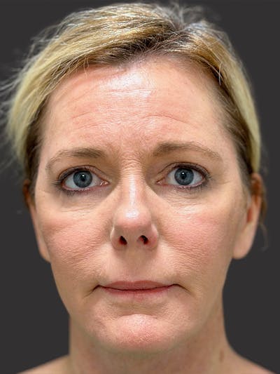 Facelift Before & After Gallery - Patient 197290 - Image 2