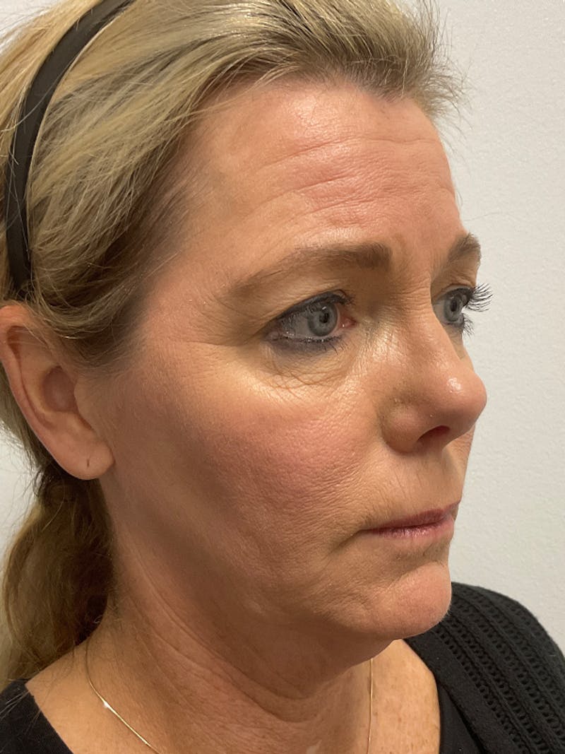 Neck Lift Before & After Gallery - Patient 236108 - Image 9