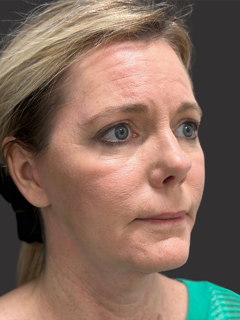 Neck Lift Before & After Gallery - Patient 236108 - Image 10
