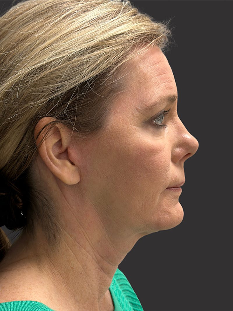 Neck Lift Before & After Gallery - Patient 236108 - Image 8