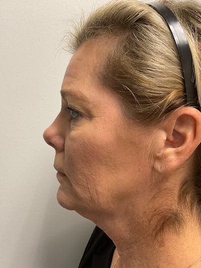 Neck Lift Before & After Gallery - Patient 236108 - Image 1