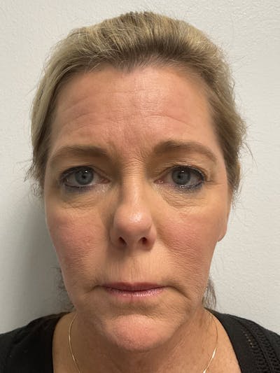 Facelift Before & After Gallery - Patient 197290 - Image 1