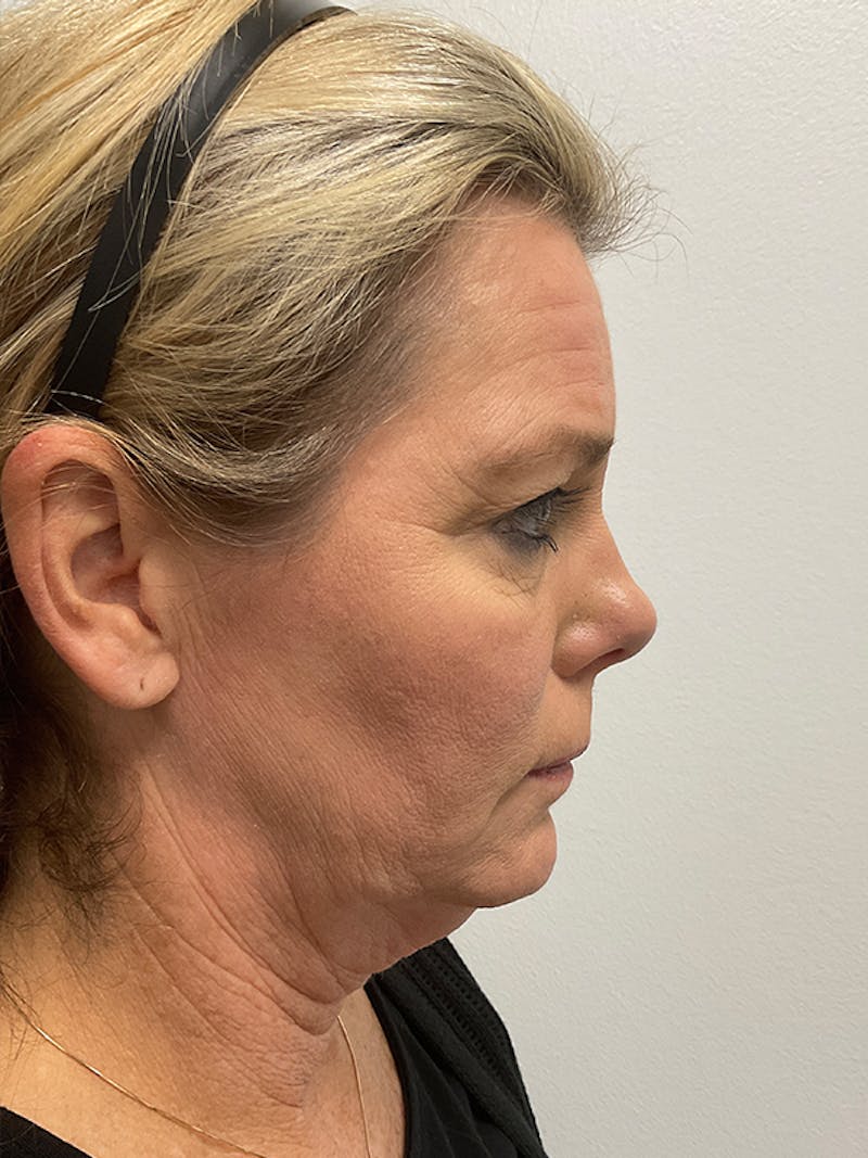 Neck Lift Before & After Gallery - Patient 236108 - Image 7