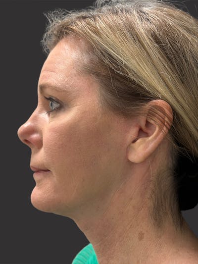 Neck Lift Before & After Gallery - Patient 236108 - Image 2