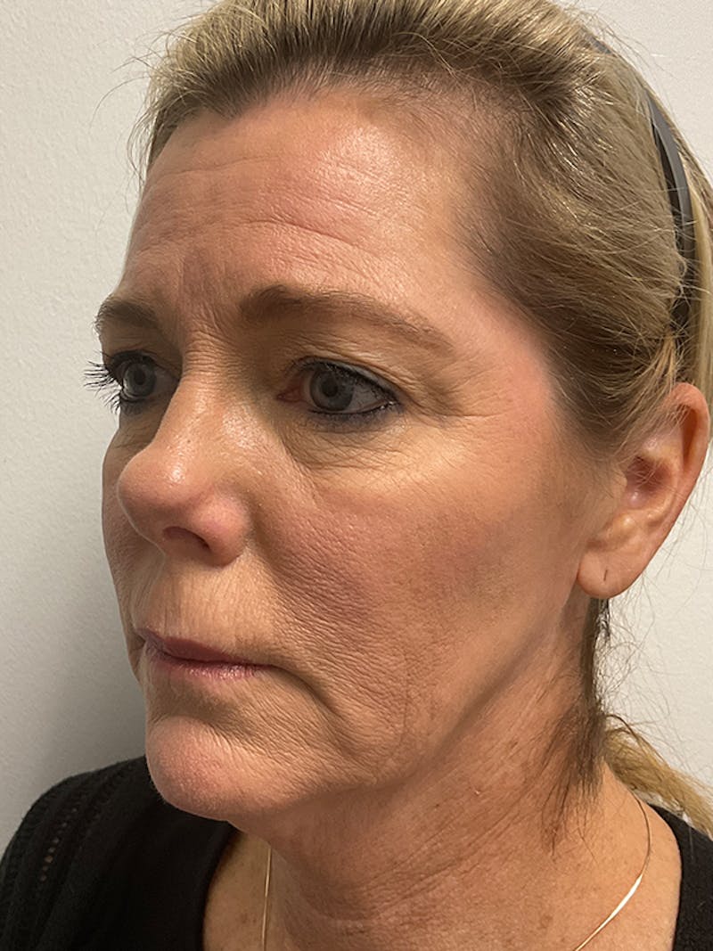 Neck Lift Before & After Gallery - Patient 236108 - Image 3