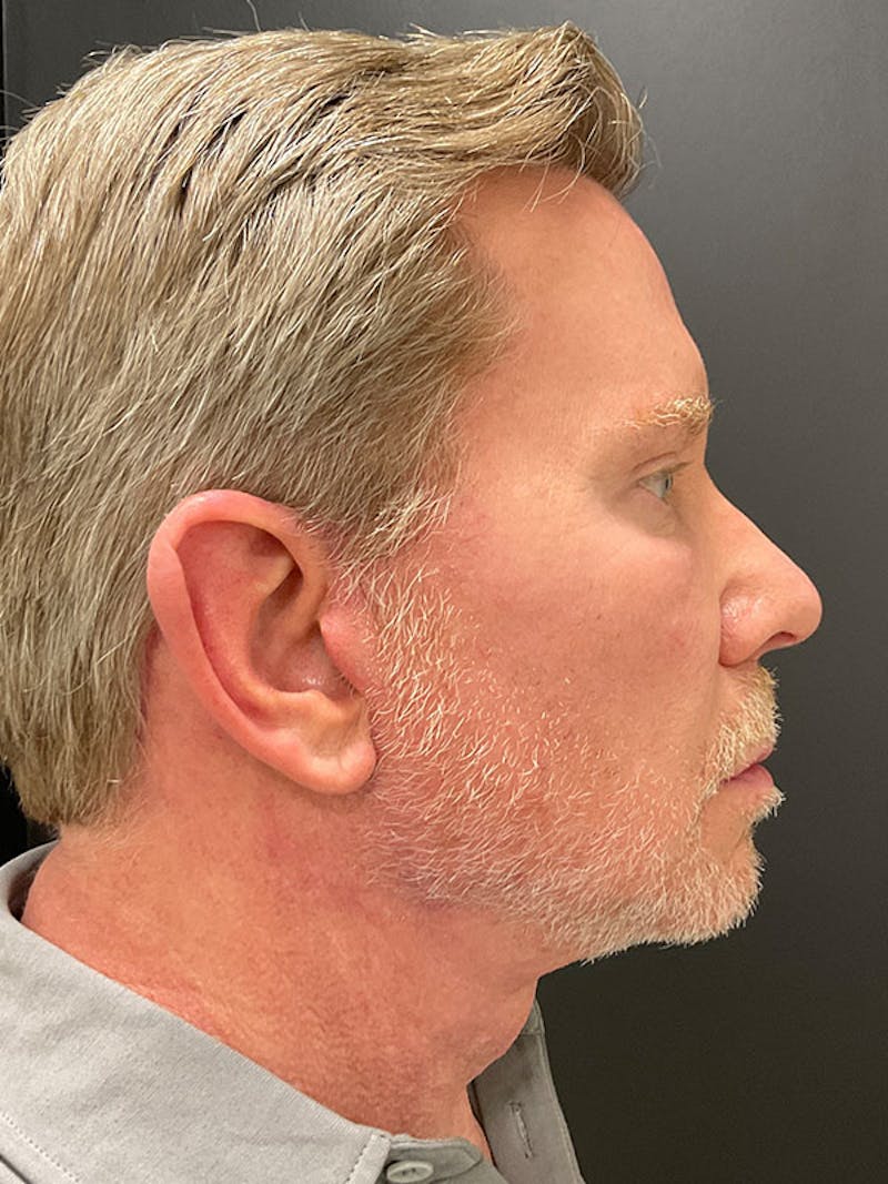 Neck Lift Before & After Gallery - Patient 271121 - Image 8