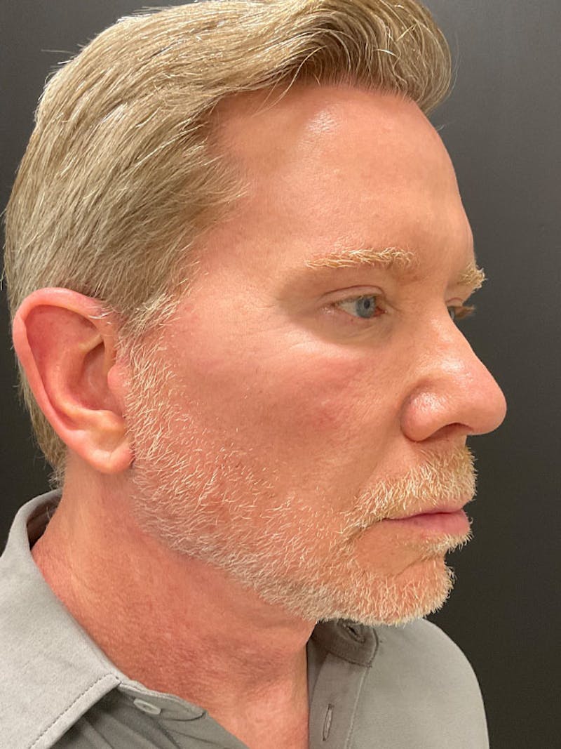 Neck Lift Before & After Gallery - Patient 271121 - Image 10