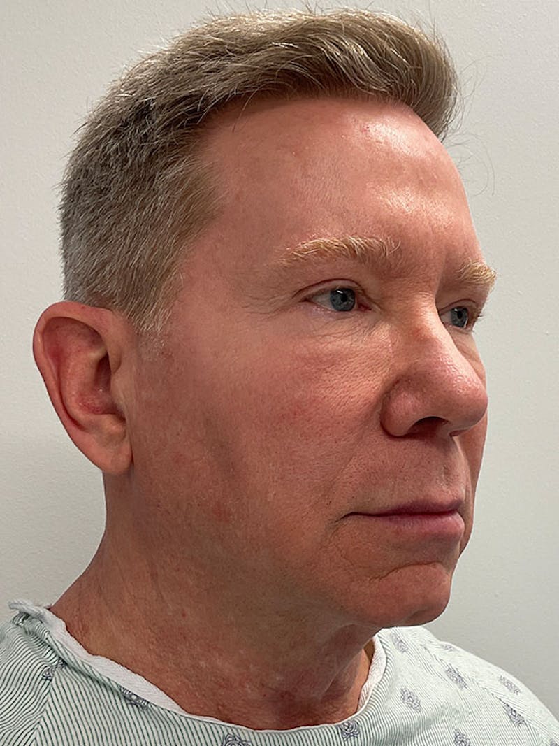 Neck Lift Before & After Gallery - Patient 271121 - Image 9