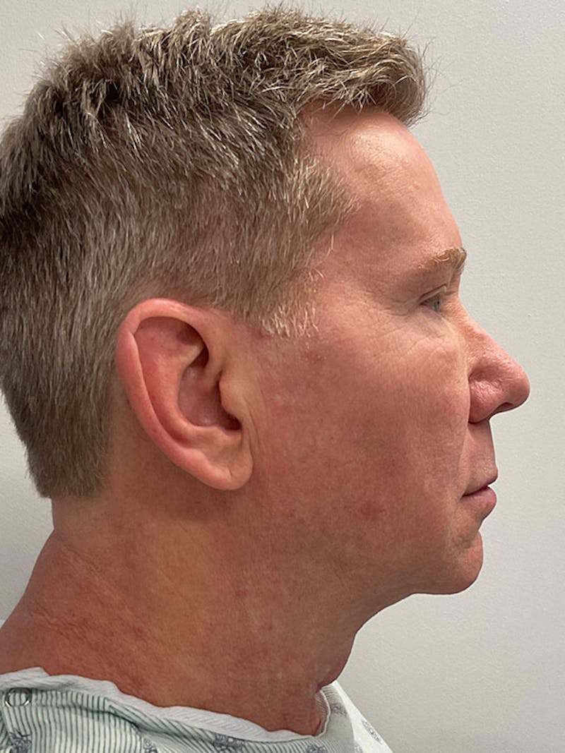 Neck Lift Before & After Gallery - Patient 271121 - Image 7