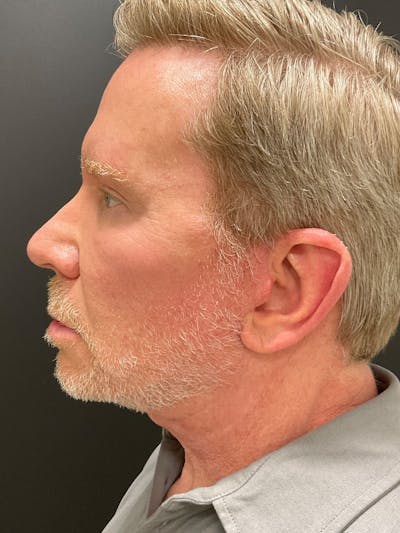 Neck Lift Before & After Gallery - Patient 271121 - Image 2