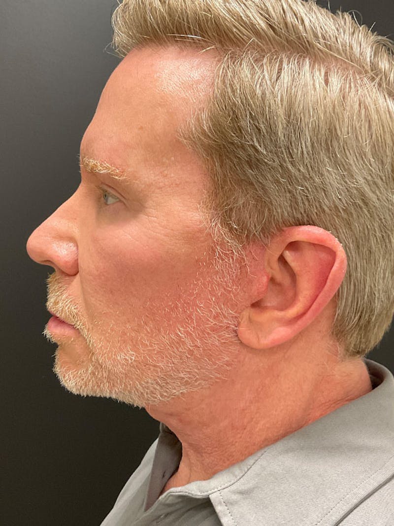 Neck Lift Before & After Gallery - Patient 271121 - Image 2