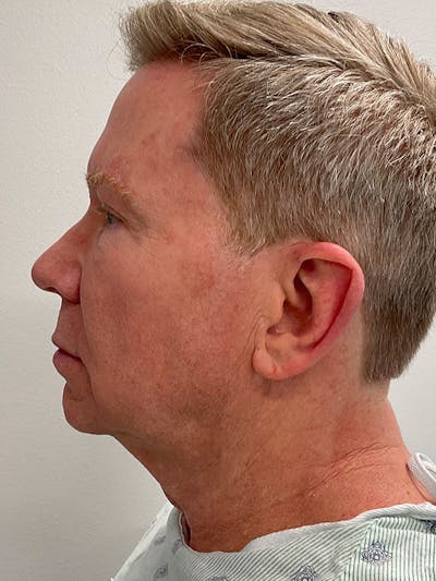 Neck Lift Before & After Gallery - Patient 271121 - Image 1
