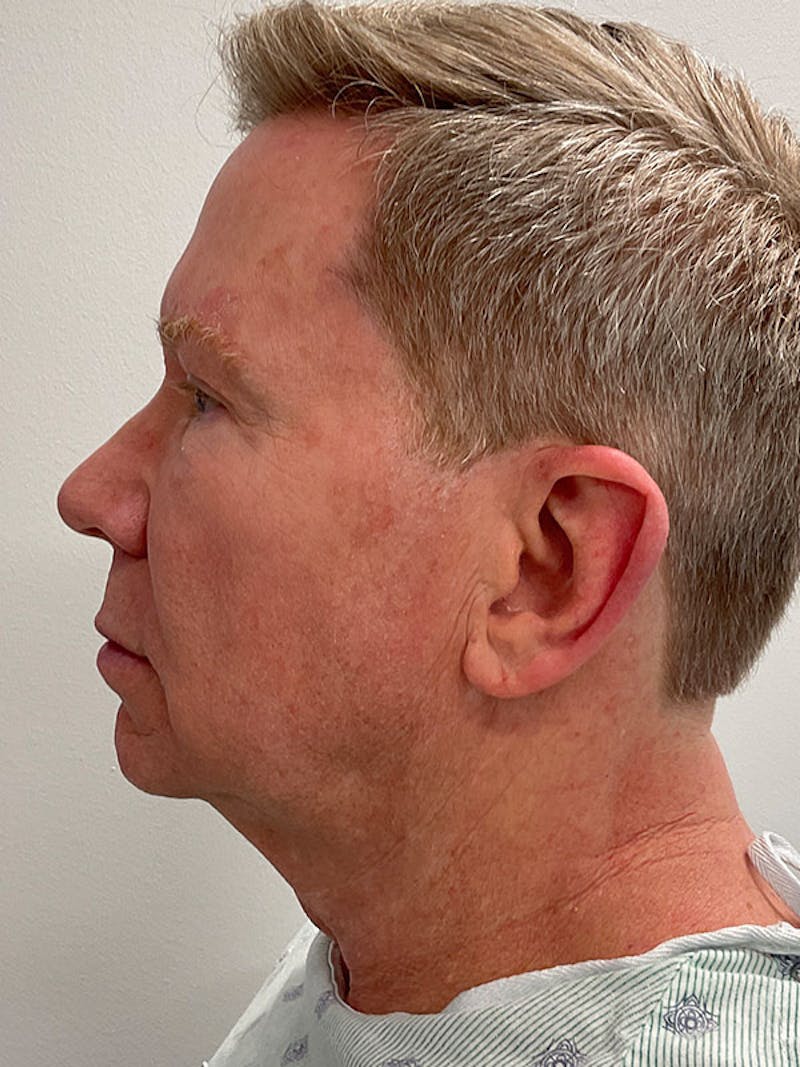 Neck Lift Before & After Gallery - Patient 271121 - Image 1
