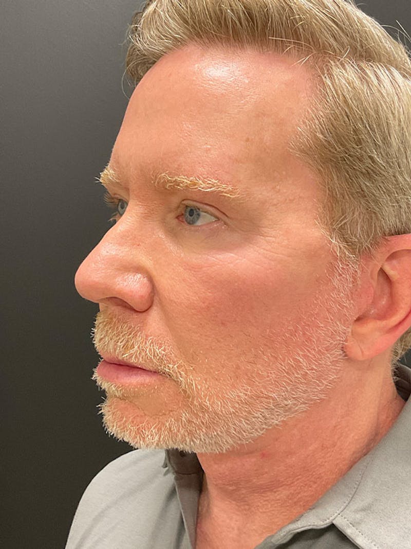 Neck Lift Before & After Gallery - Patient 271121 - Image 4