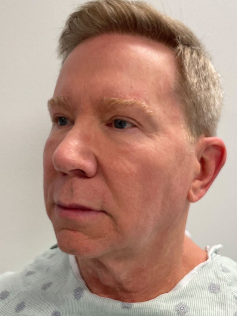 Neck Lift Before & After Gallery - Patient 271121 - Image 3
