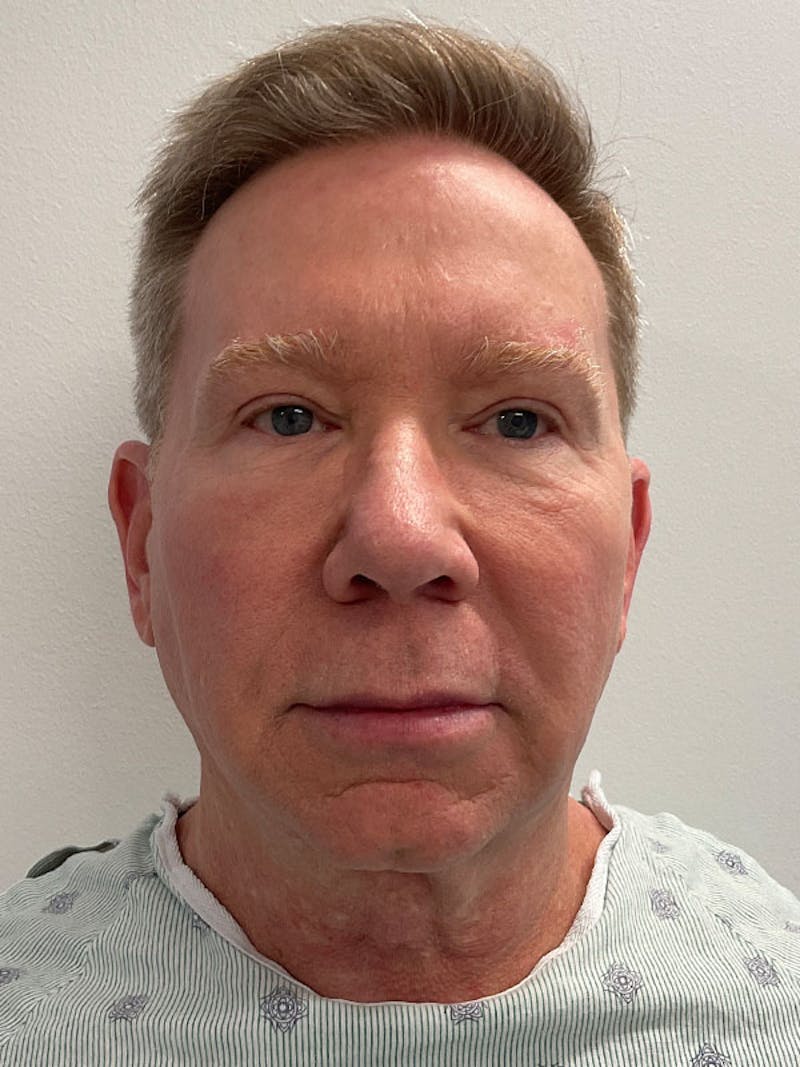 Neck Lift Before & After Gallery - Patient 271121 - Image 5