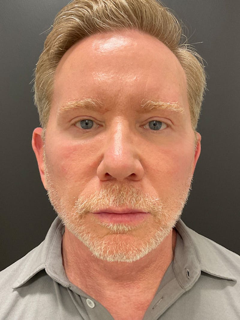 Neck Lift Before & After Gallery - Patient 271121 - Image 6
