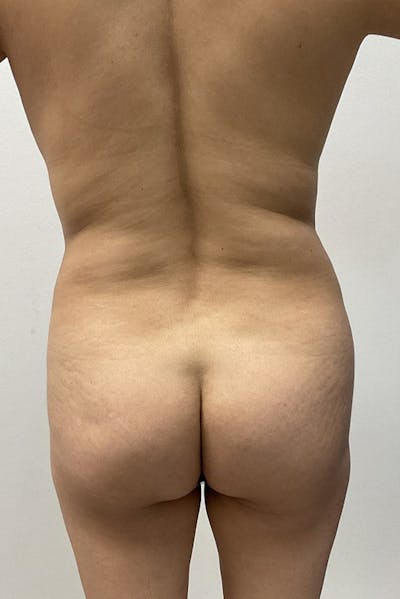 Brazilian Butt Lift Before & After Gallery - Patient 236232 - Image 1