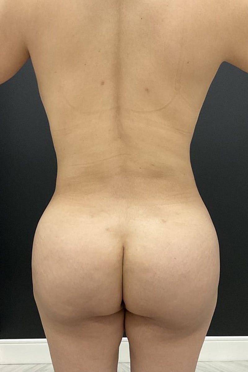 Brazilian Butt Lift Before & After Gallery - Patient 236232 - Image 2