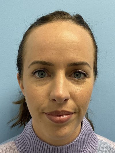 Forehead Reduction Before & After Gallery - Patient 384867 - Image 1