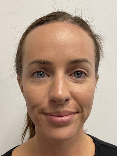 Forehead Reduction Before & After Gallery - Patient 384867 - Image 2