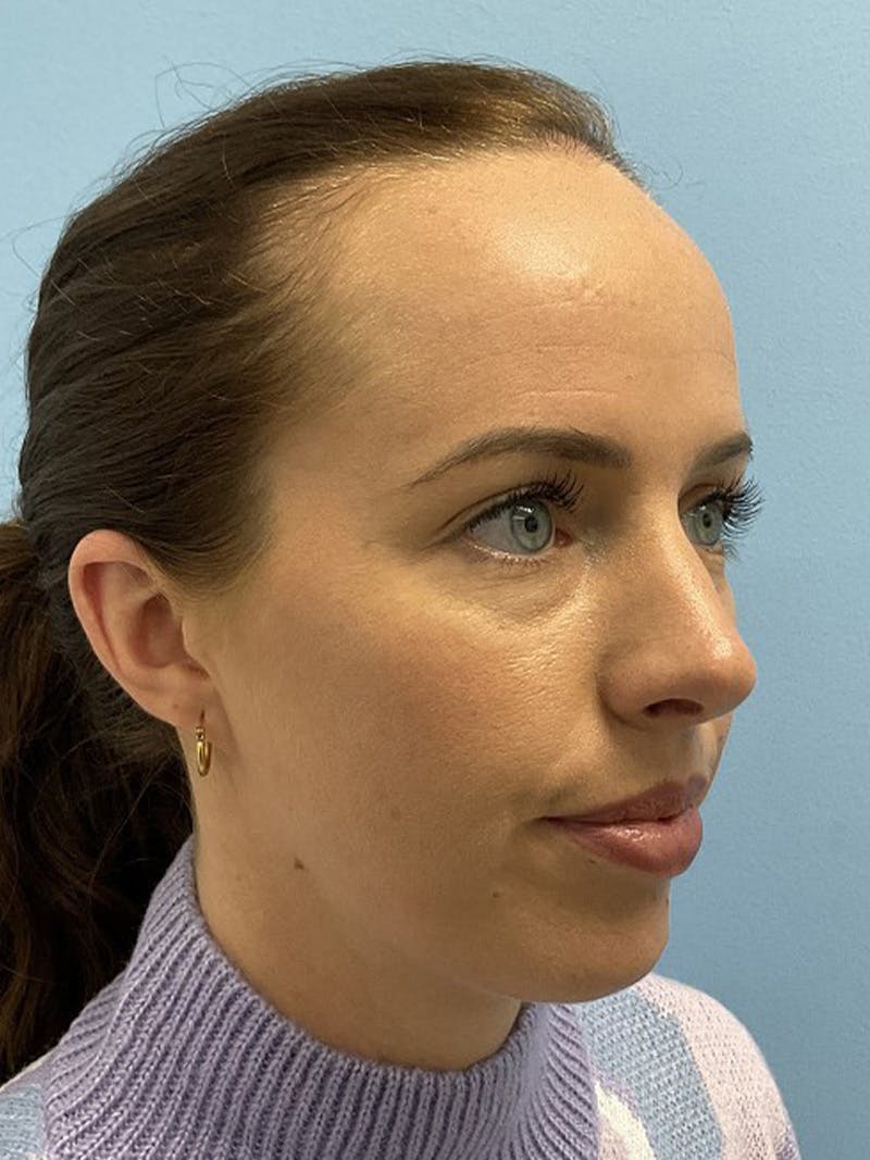 Forehead Reduction Before & After Gallery - Patient 384867 - Image 3