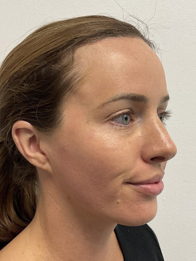 Forehead Reduction Before & After Gallery - Patient 384867 - Image 4