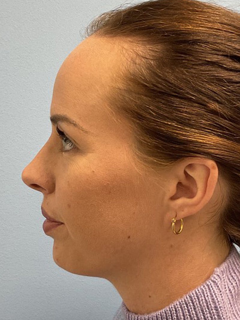 Forehead Reduction Before & After Gallery - Patient 384867 - Image 5