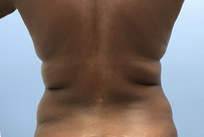 Mommy Makeover Before & After Gallery - Patient 402955 - Image 5