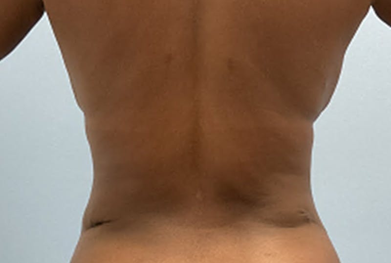 Mommy Makeover Before & After Gallery - Patient 402955 - Image 6