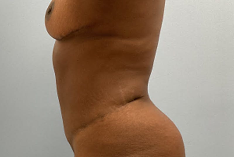 Mommy Makeover Before & After Gallery - Patient 402955 - Image 4