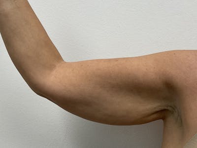 Brachioplasty Before & After Gallery - Patient 356709 - Image 1