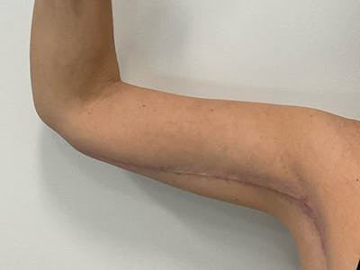 Brachioplasty Before & After Gallery - Patient 356709 - Image 2