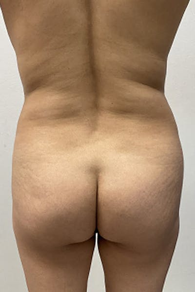 Brazilian Butt Lift Before & After Gallery - Patient 154583 - Image 1