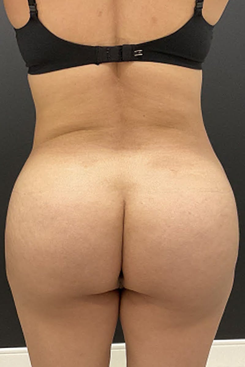 Brazilian Butt Lift Before & After Gallery - Patient 154583 - Image 2