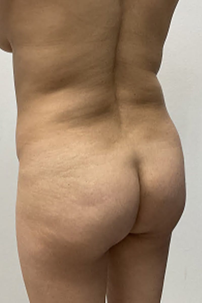 Brazilian Butt Lift Before & After Gallery - Patient 154583 - Image 3
