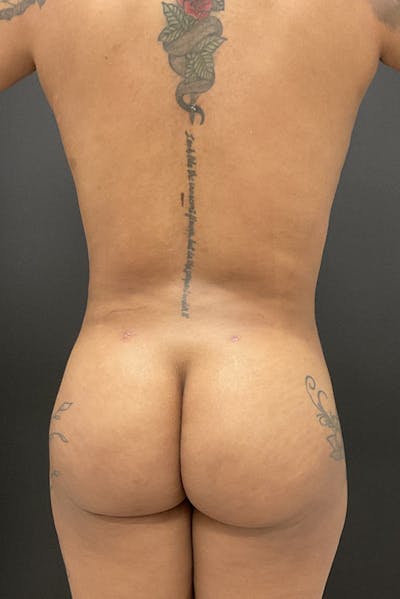 Brazilian Butt Lift Before & After Gallery - Patient 411124 - Image 2