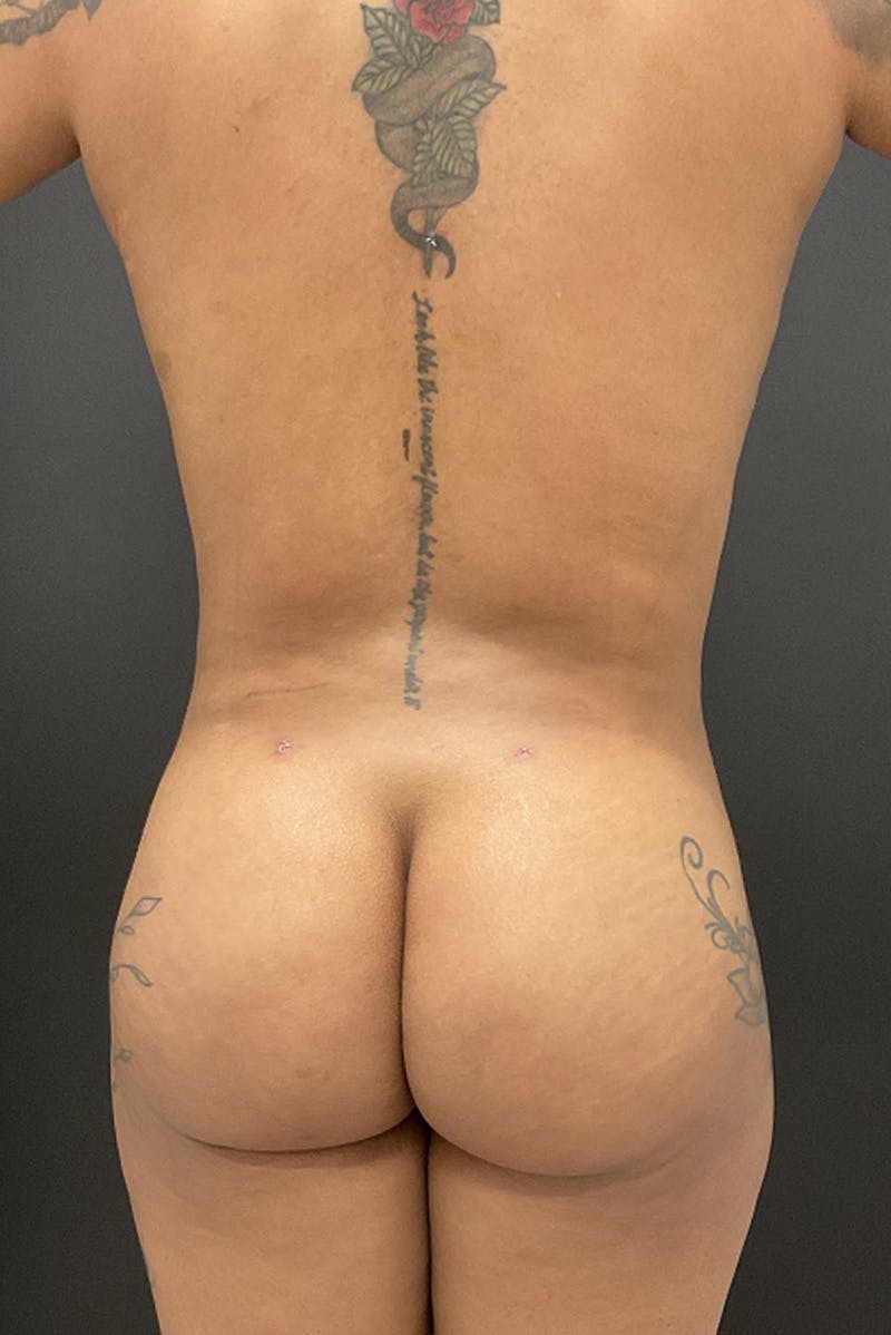 Brazilian Butt Lift Before & After Gallery - Patient 411124 - Image 2