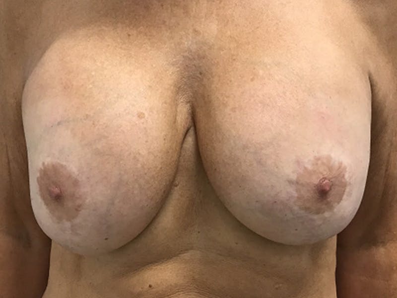 Breast Revision Before & After Gallery - Patient 380906 - Image 1