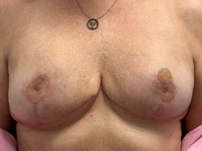 Breast Revision Before & After Gallery - Patient 380906 - Image 2