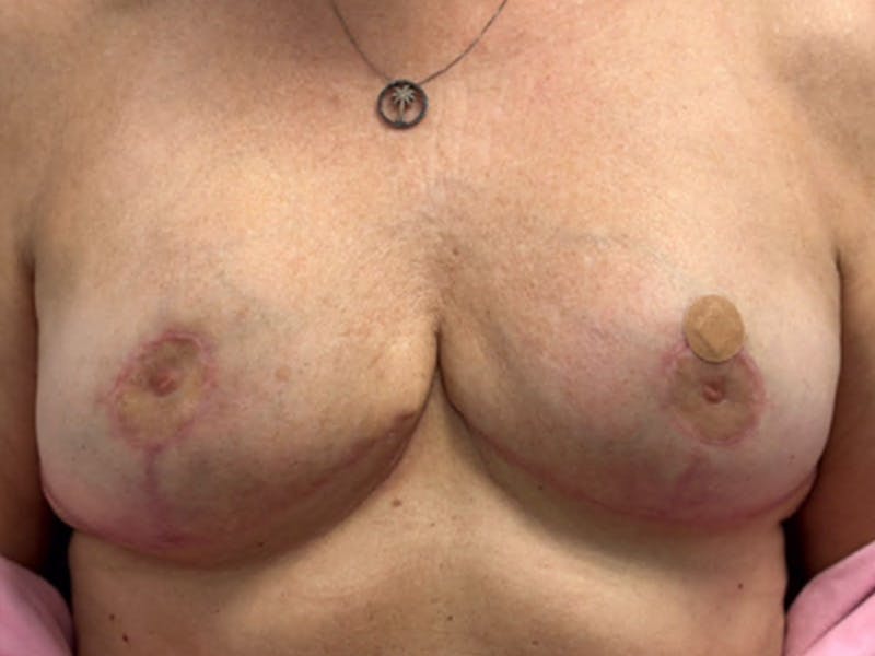 Breast Revision Before & After Gallery - Patient 380906 - Image 2