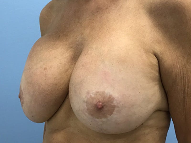Breast Revision Before & After Gallery - Patient 380906 - Image 3